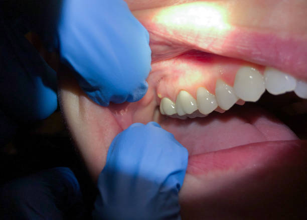 Best Knocked-Out Tooth (Avulsed Tooth) Treatment in Glendale, MS
